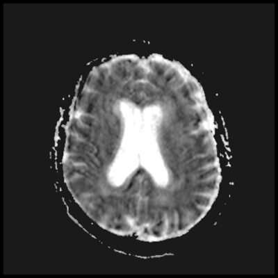 Motion artifact ADC MRI Motion artifact ADC MRI