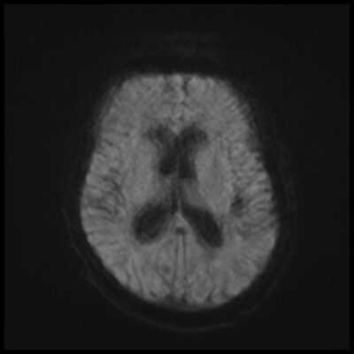 Motion artifact DWI MRI 1 Motion artifact DWI MRI 1