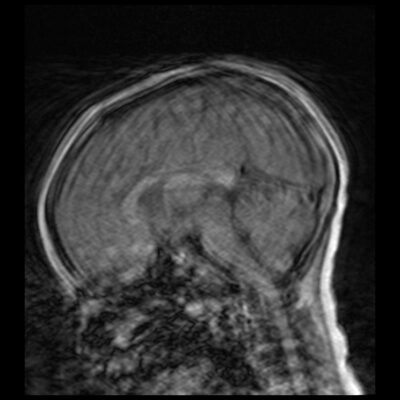 Motion artifact MRI BRAIN Motion artifact MRI BRAIN