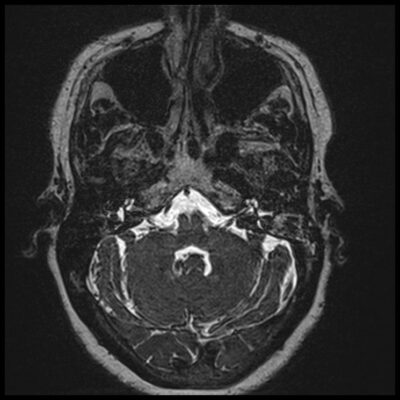 Motion artifact MRI IAM Motion artifact MRI IAM