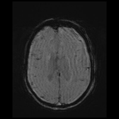Motion artifact MRI SWI Motion artifact MRI SWI