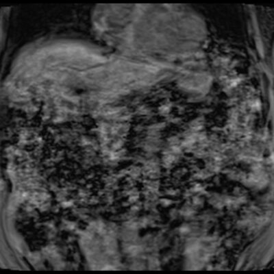 Motion artifact MRI abdomen Motion artifact MRI abdomen