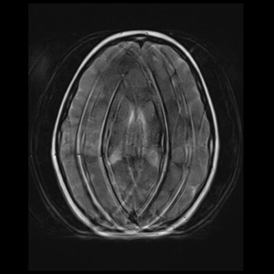 Motion artifact MRI brain t2 Motion artifact MRI brain t2