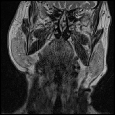 Motion artifact MRI neck Motion artifact MRI neck