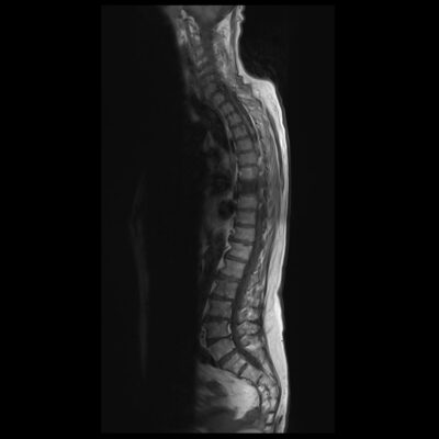 Motion artifact SPINE MRI Motion artifact SPINE MRI