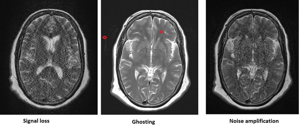 Parallel imaging(ipat) artifact MRI