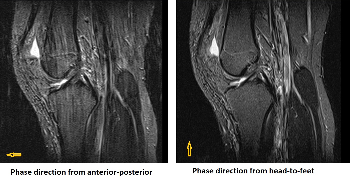 Phase direction and MRI flow artifact