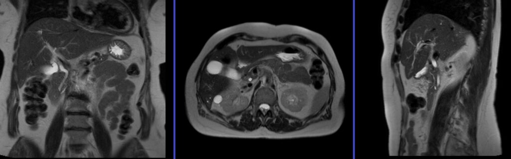 Planning and protocol of Magnetic resonance cholangiopancreatography (MRCP) localiser