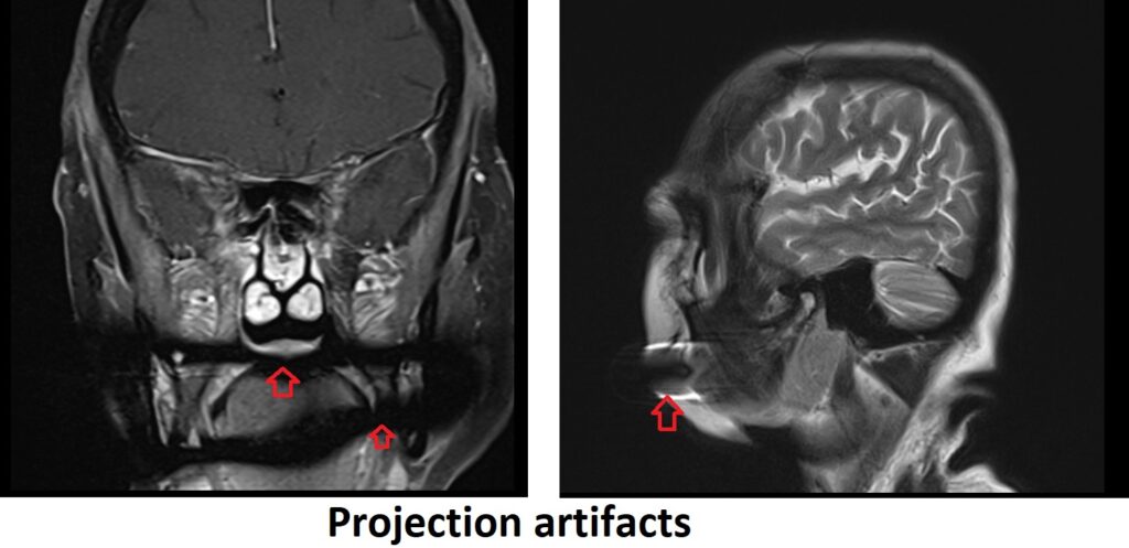 Projection artifacts in MRI