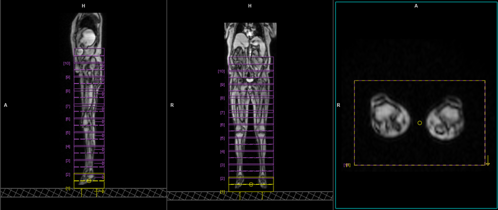 QISS Non contrast MRA (Quiescent-Inflow Single-Shot Magnetic Resonance Angiography) planning and protocol