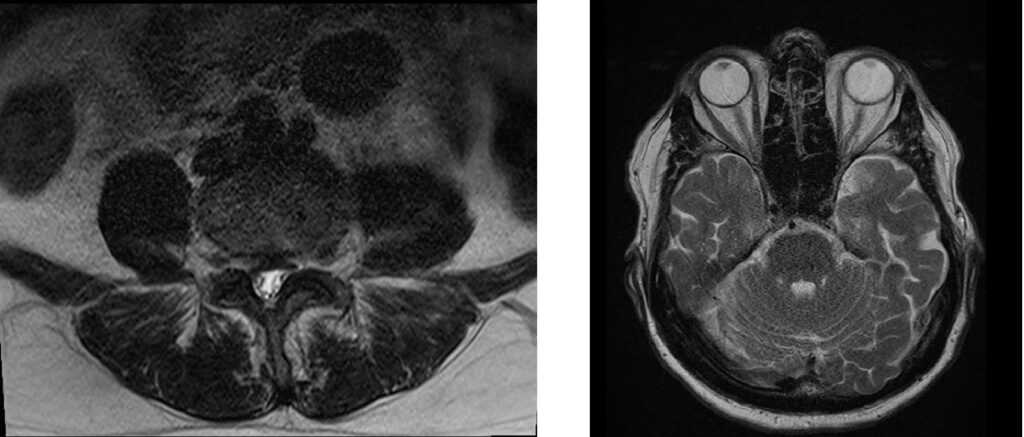 Signal-to-noise ratio (SNR)-related artifacts in MRI
