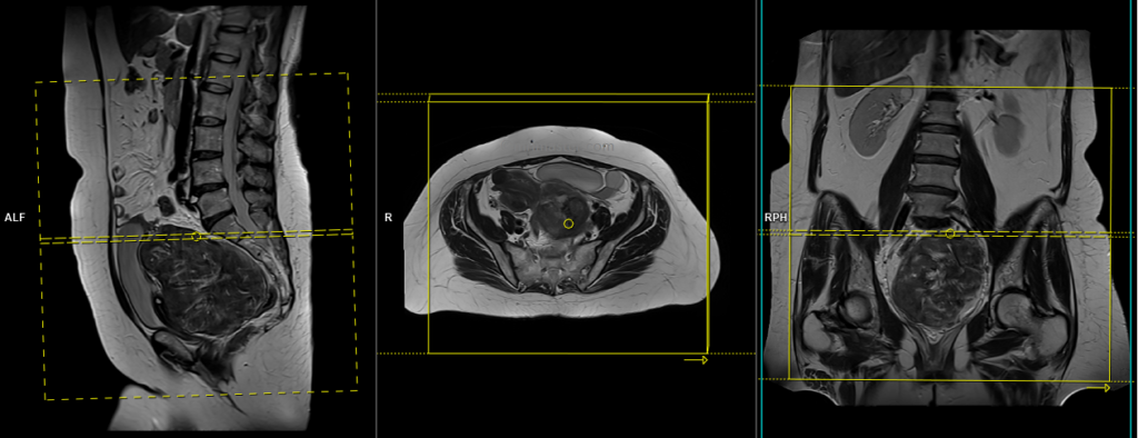 Uterine fibroids MRI protocol and planning of axial abdomen and pelvis scans