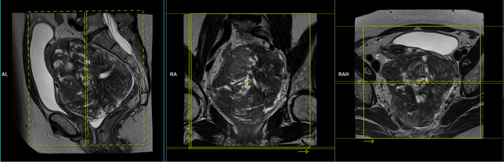 Uterine fibroids MRI protocol and planning of coronal scans
