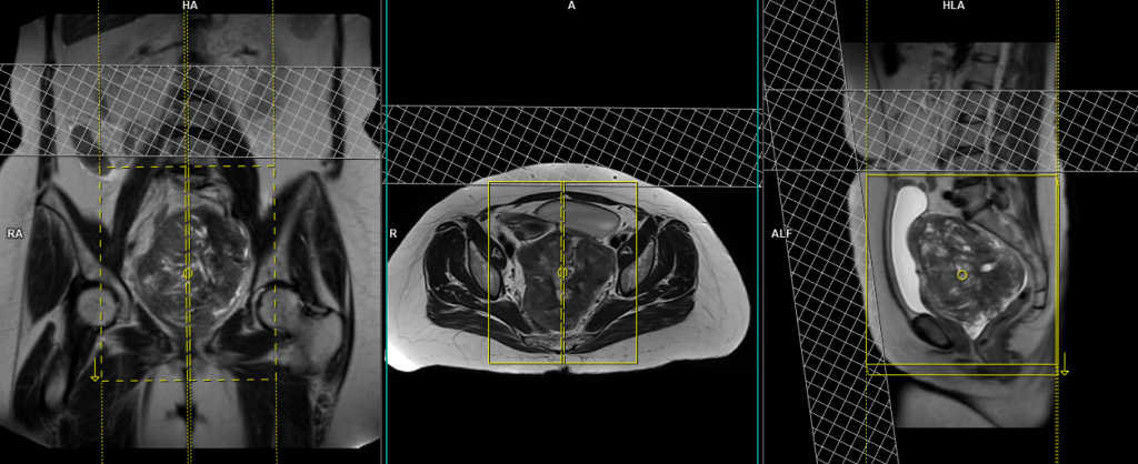 Uterine fibroids MRI protocol and planning of sagittal scans