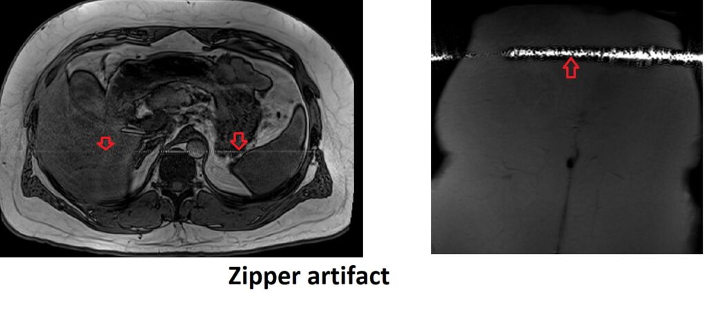 Zipper artifact mri