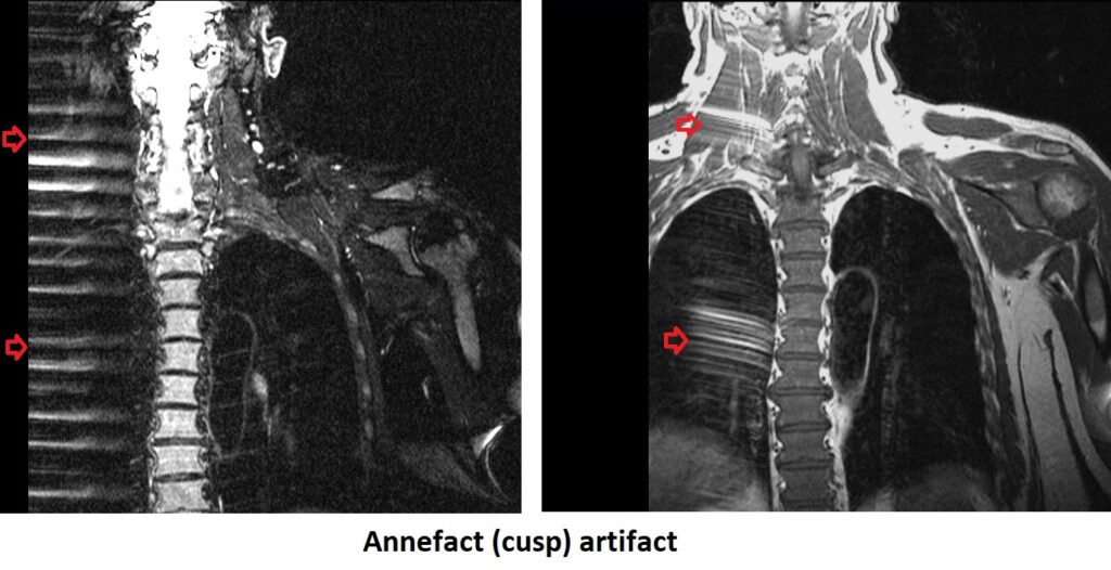 annefact (cusp) artifact