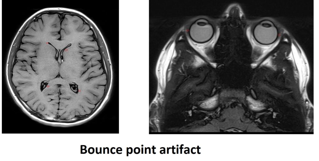 bounce point artifact MRI