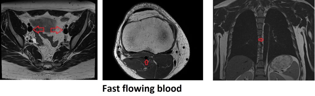 fast flowing blood Flow Void artifact