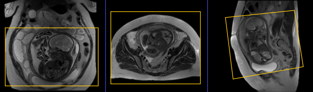 fetal abdomen MRI planning and protocol of axial large fov scans