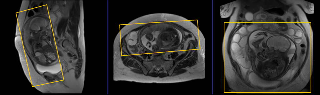 fetal abdomen MRI planning and protocol of coronal large fov scans