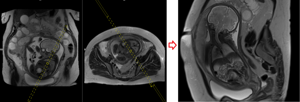 fetal abdomen MRI planning and protocol of coronal localiser scan