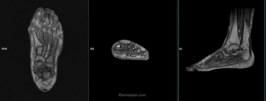 foot mri localizer