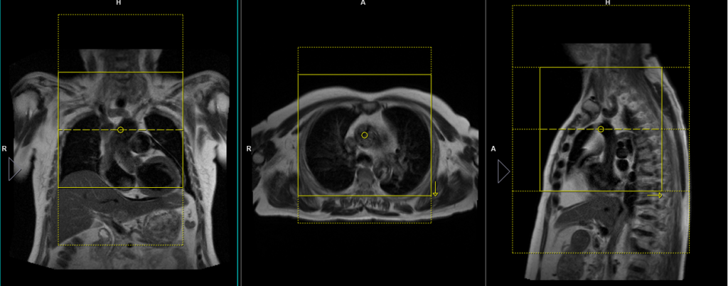 mediastinum MRI protocol and planning of axial small FOV scan