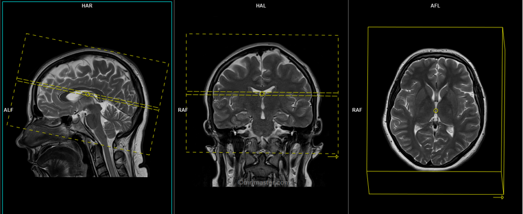 mri brain protocol and planning of axial DWI scans