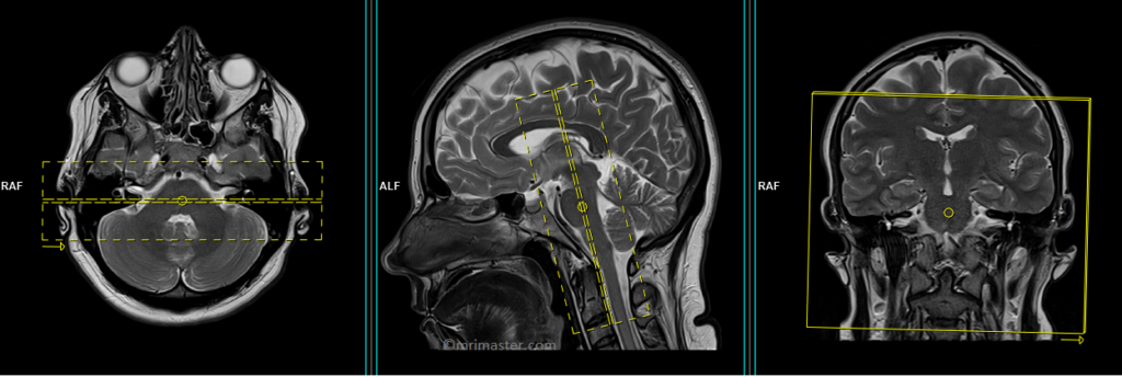 MRI planing and protocol of iam coronal T1 scans