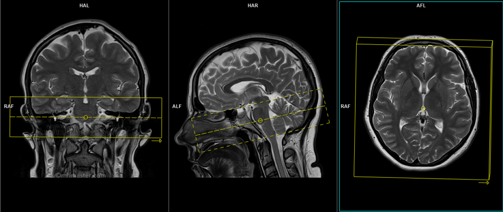 mri planing of iam axial cissor SPACE 3D