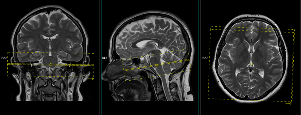 MRI planing of iam axial T1 scans
