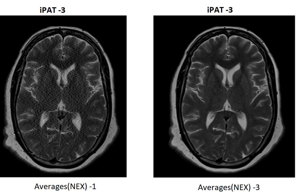 parallel imaging and SNR