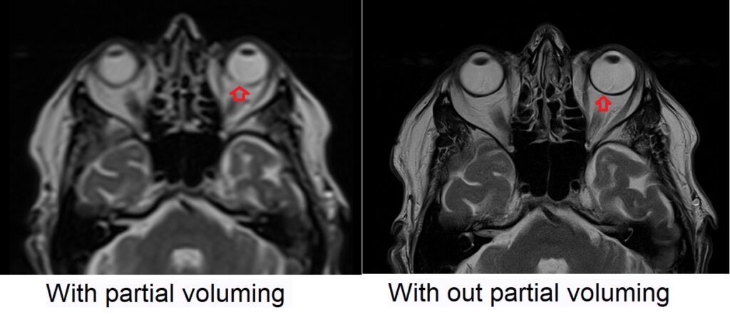partial voluming artifact mri