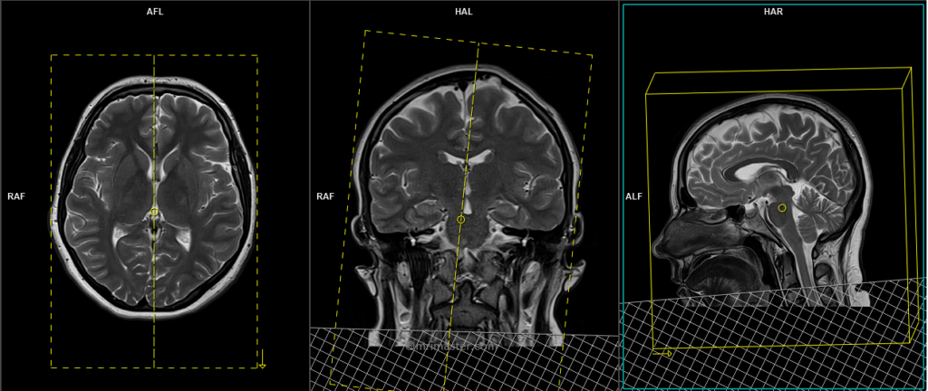 planning of mrv brain
