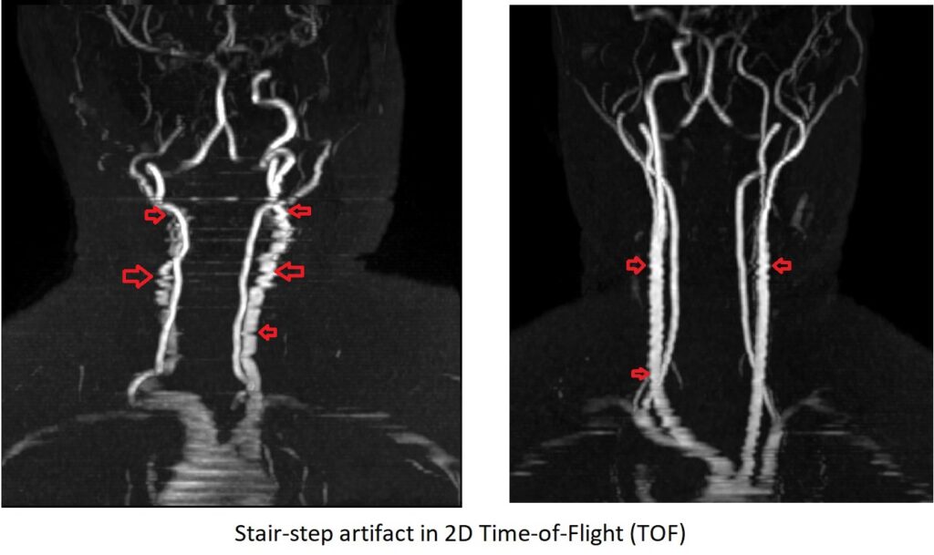 stair-step artifact in 2D Time-of-Flight (TOF)