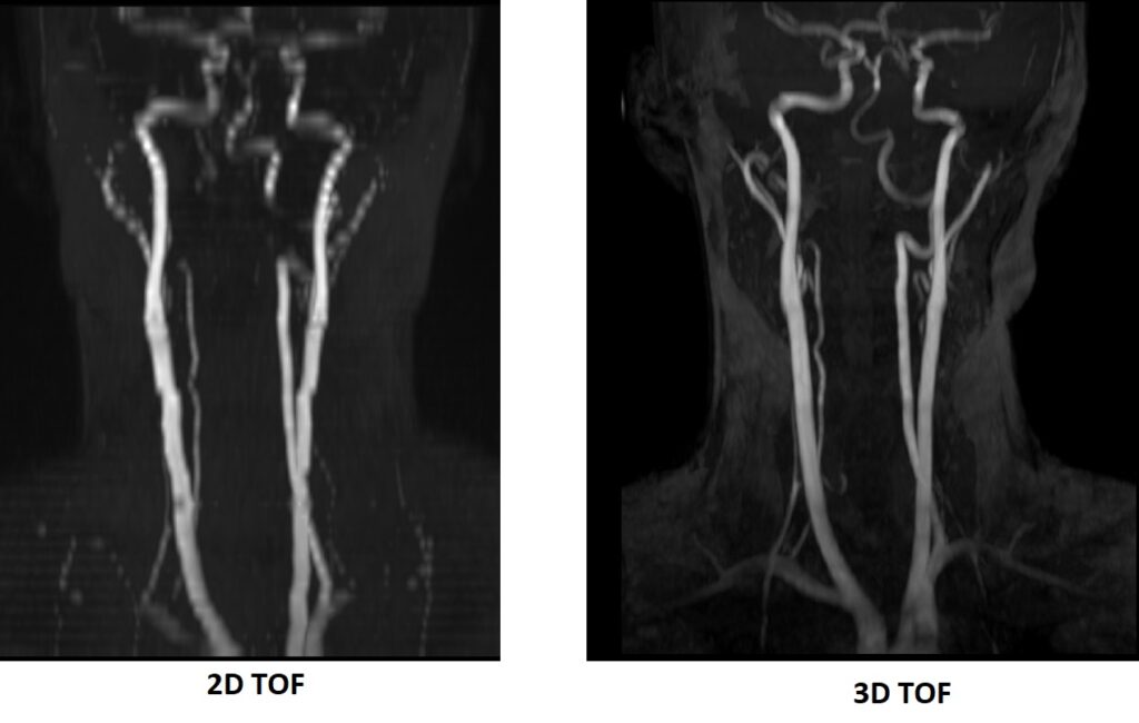 stair-step artifact in 2D Time-of-Flight (TOF) artifact reduction using 3d tof