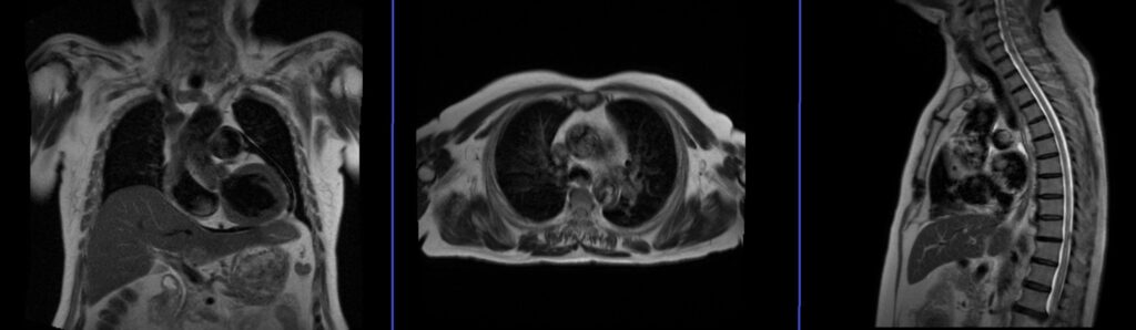 thymus mri localiser