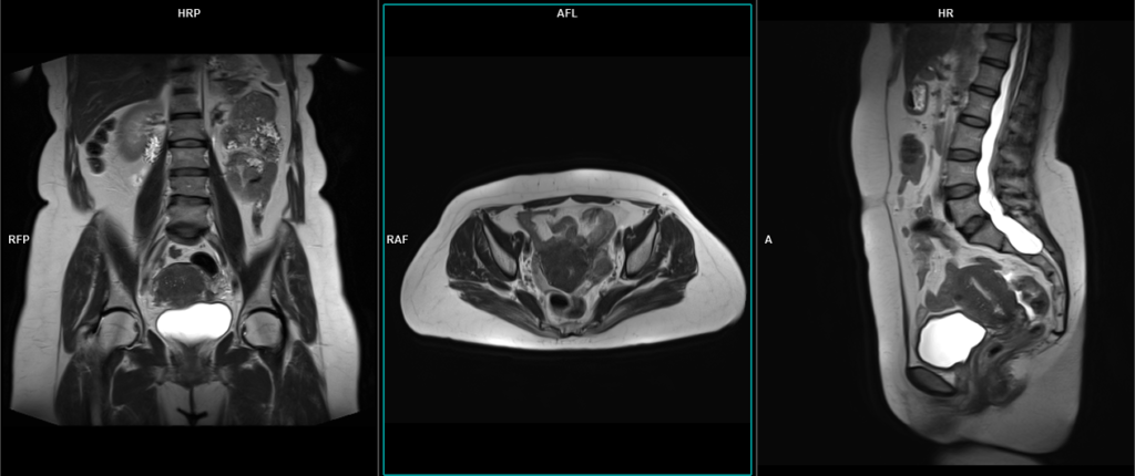 Carcinoma of the cervix MRI localiser image