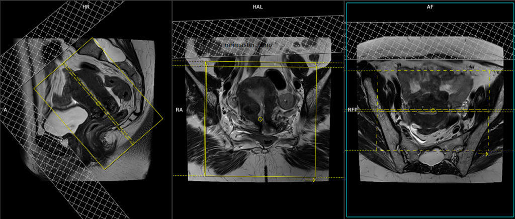 Carcinoma of the cervix MRI prptocol and planning of coronal scans
