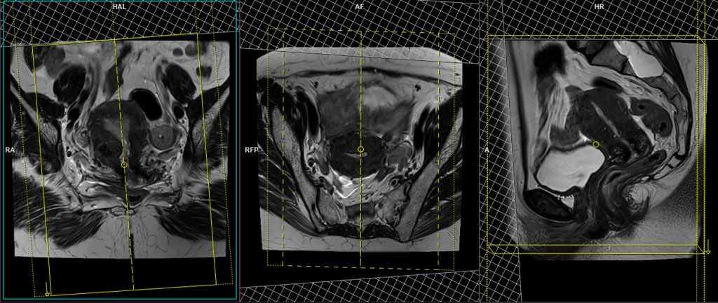 Carcinoma of the cervix MRI prptocol and planning of sagittal dynamic scans