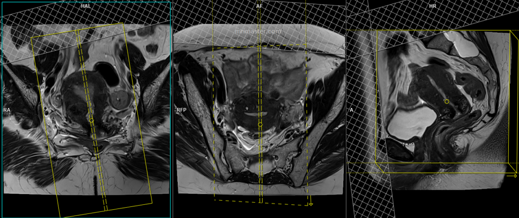 Carcinoma of the cervix MRI prptocol and planning of sagittal scans