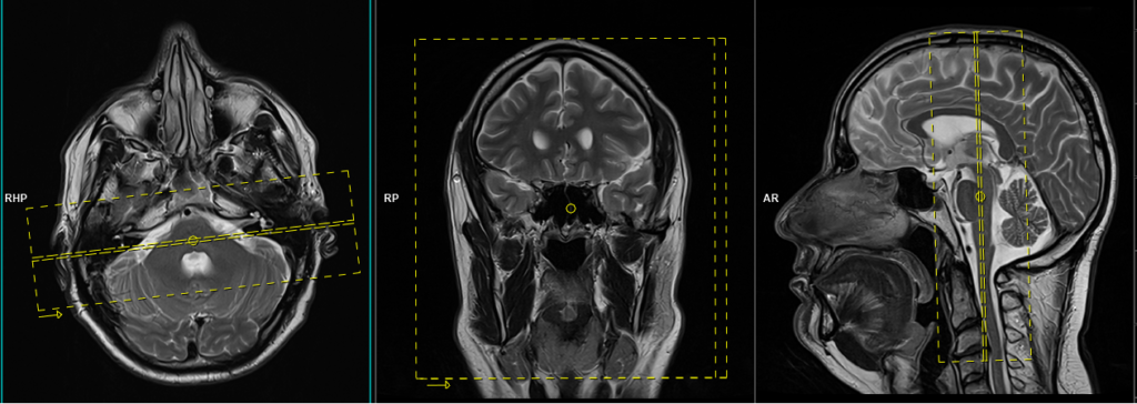 IAM Diffusion Weighted (Cholesteatoma protocol) HASTE DWI planning