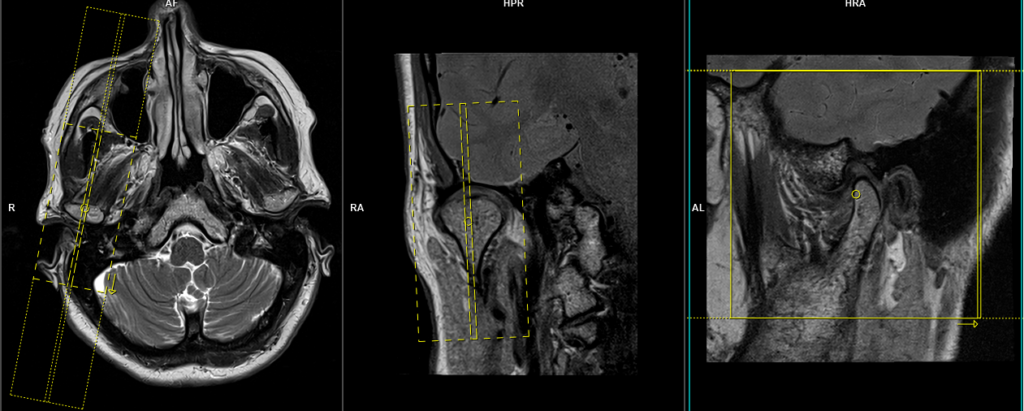 MRI TMJ Planning of sagittal right side open mouth scans