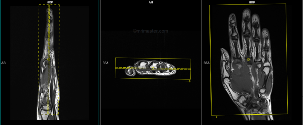 MRI hand coronal planning