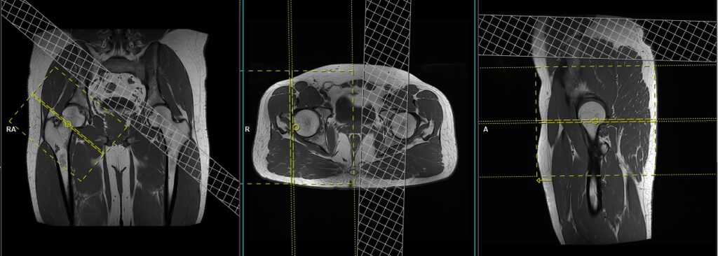 MRI hip planning and protocol of sagittal oblique scans
