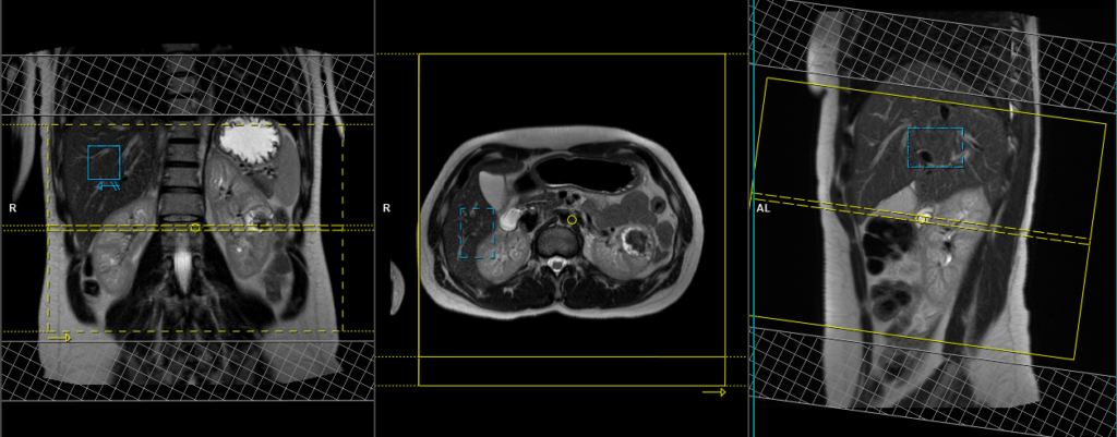 MRI kidneys (respiratory gated) protocol and planning of axial scan