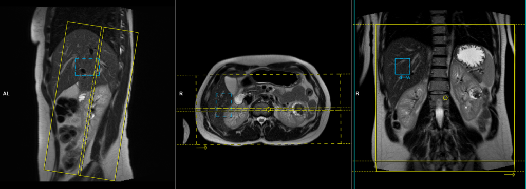 MRI kidneys (respiratory gated) protocol and planning of coronal scan