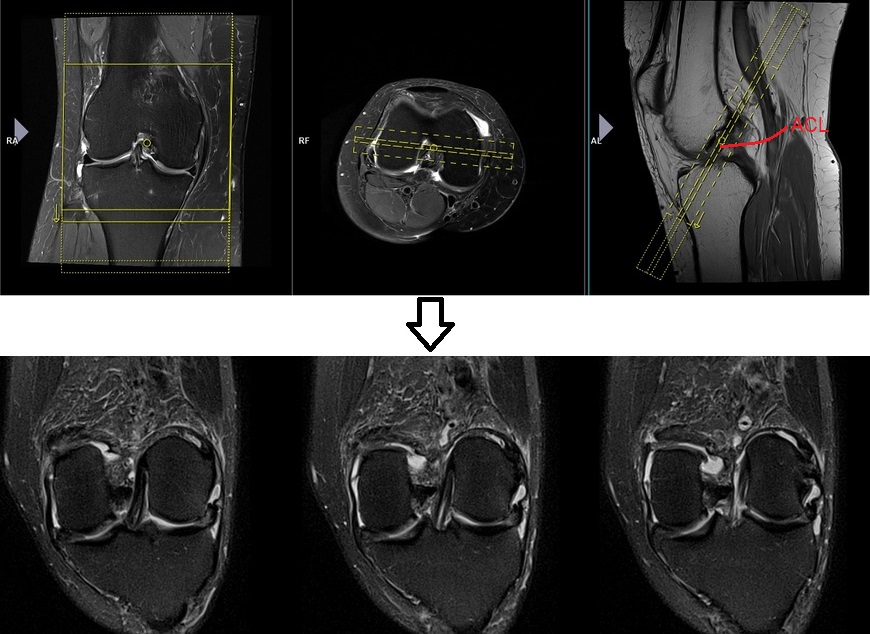 MRI knee protocol and planning for coronal anterior cruciate ligament(ACL)
