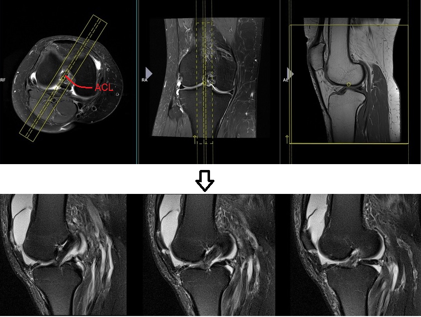 MRI knee protocol and planning for sagittal anterior cruciate ligament(ACL)