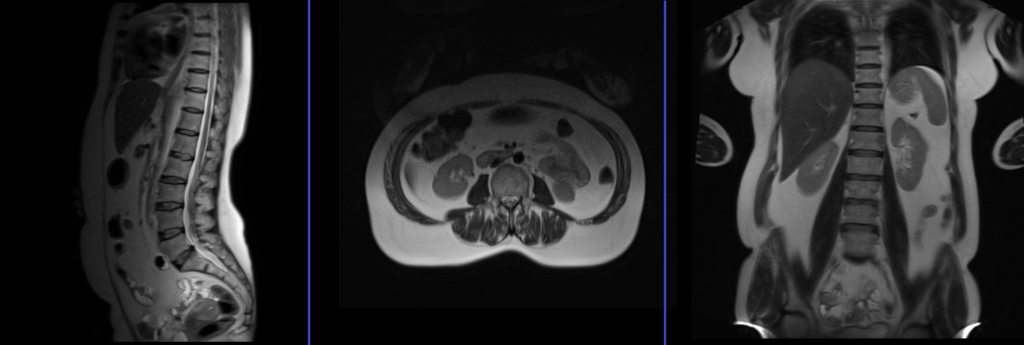 MRI lumbar spine localiser